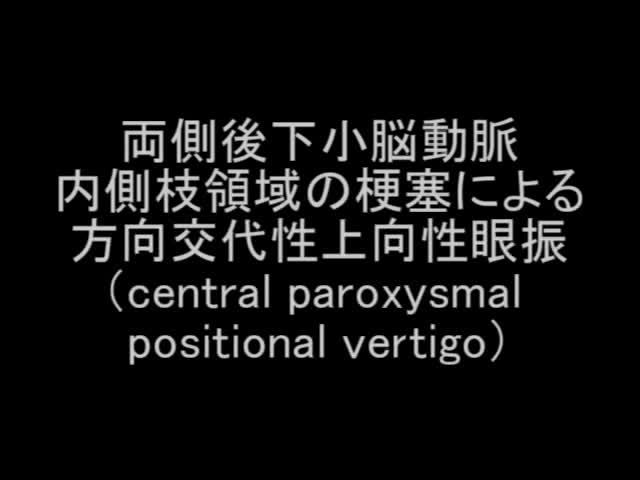 VTR13　両側後下小脳動脈領域の梗塞による方向交代性上向性眼振（central paroxysma...