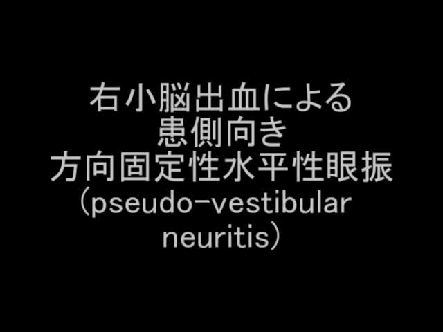 VTR12　右小脳出血による方向固定性水平性眼振（pseudo-vestibular neuriti...