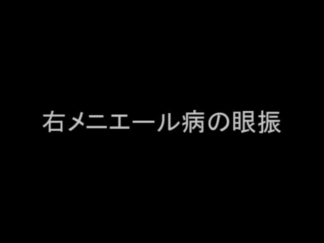 VTR11　右メニエール病の眼振（12秒）