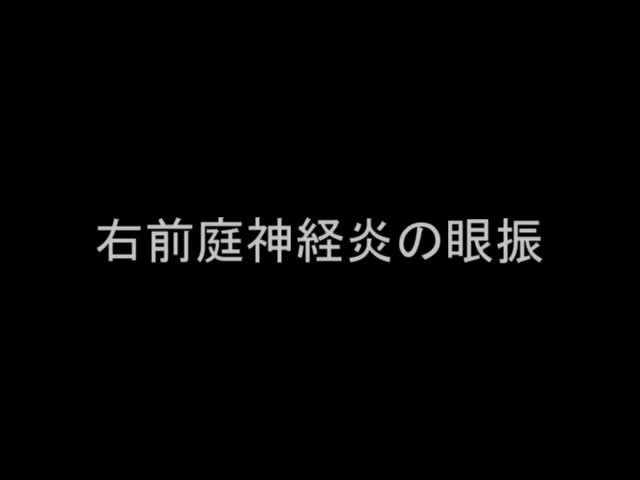 VTR10　右前庭神経炎の眼振（29秒）