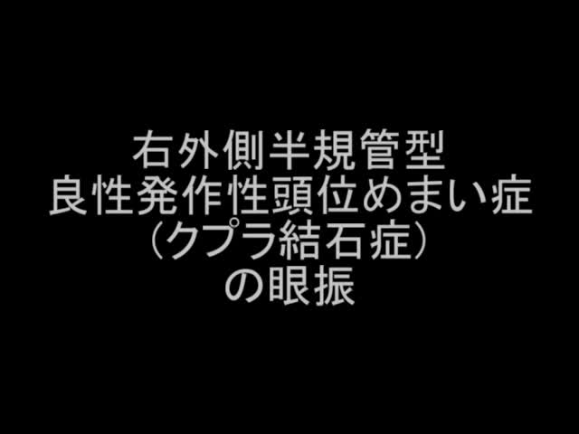 VTR4　右外側半規管型良性発作性頭位めまい症（クプラ結石症）の眼振（3分52秒）...