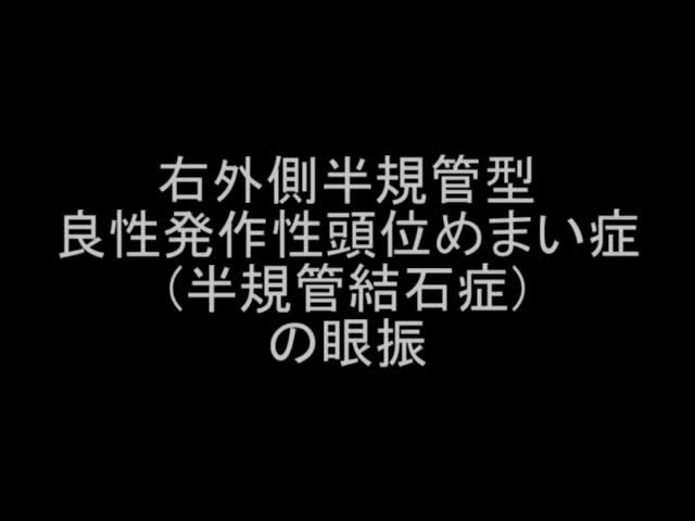 VTR3　右外側半規管型良性発作性頭位めまい症（半規管結石症）の眼振（1分7秒）...