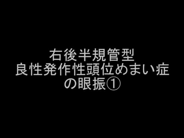 VTR1　右後半規管型良性発作性頭位めまい症の眼振1（2分12秒）...